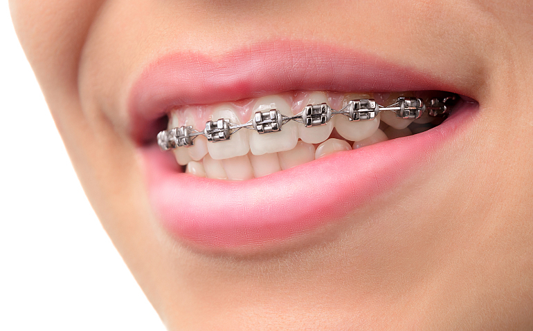 Ravni zubi - ne radi se samo o lijepom osmijehu. 4 medicinske prednosti aparatića