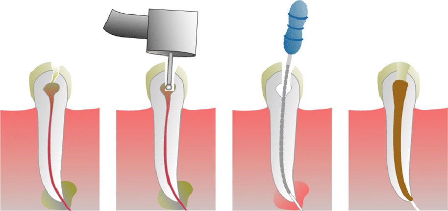 Šta je endodoncija?